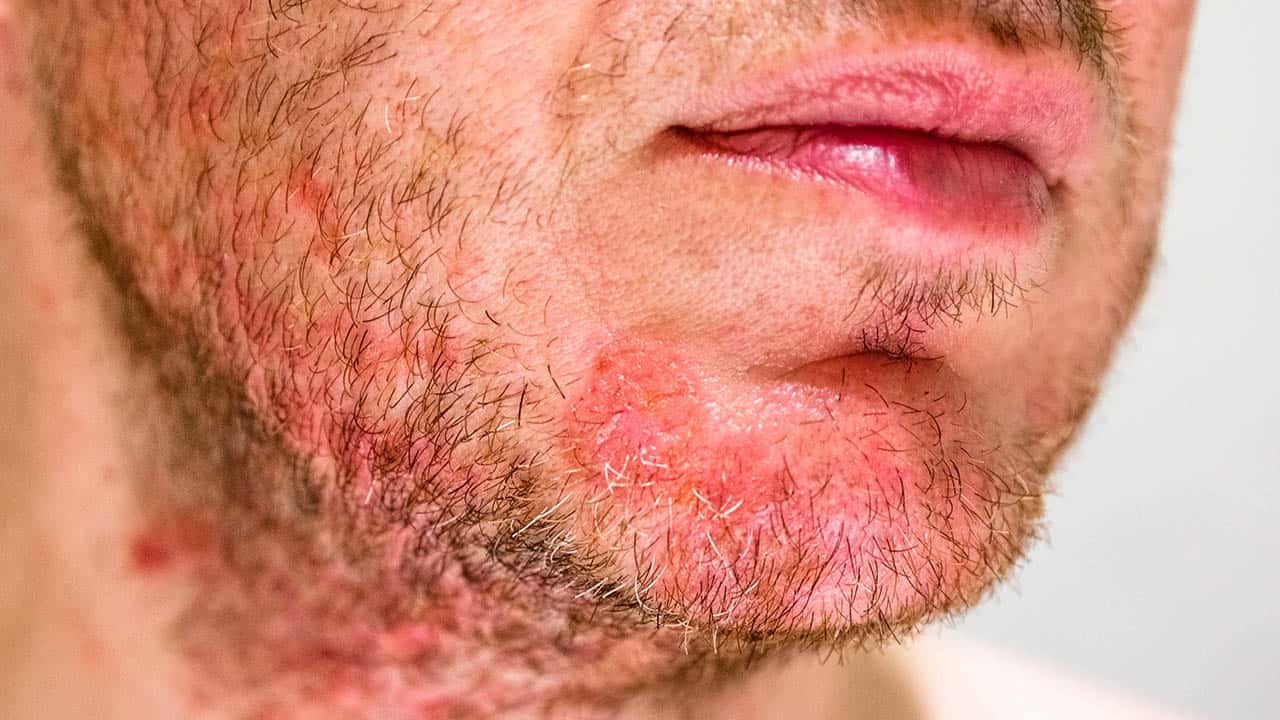 How to treat atopic dermatitis? – Chicatella